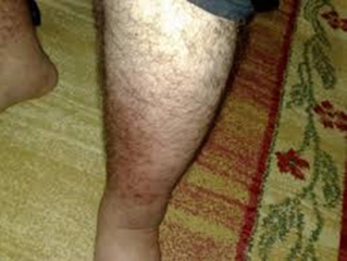 Bacakta Kızarıklık Belirtileri ve Tedavisi