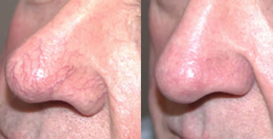 Burun Kızarıklığı Belirtileri ve Tedavisi