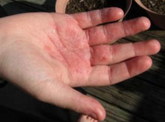 Ellerde Kızarıklık Belirtileri ve Tedavisi