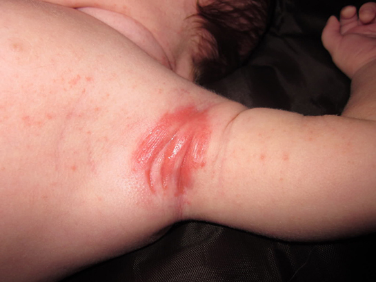 Koltuk Altında Kızarıklık Belirtileri ve Tedavisi