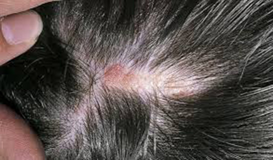 Saç Derisinde Kızarıklık Belirtileri ve Tedavisi