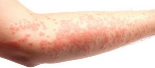 Vücutta Kızarıklık Belirtileri ve Tedavisi
